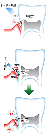 レーザー治療イメージ　虫歯・歯石除去