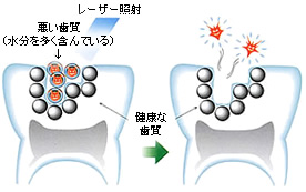 最新レーザー治療イメージ