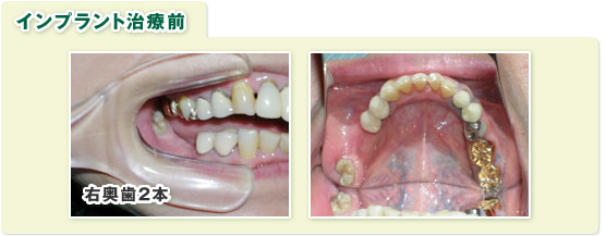 インプラント治療例