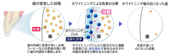 変色した歯をホワイトニングによって色素を分解、除去し白くするメカニズム