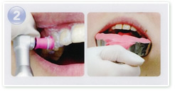 歯面のクリーニングとマウストレーの作製