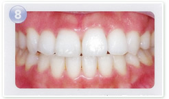 歯科医院にて、ホワイトニング効果の経過確認